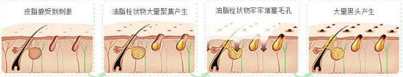 草莓鼻子怎么去掉?果酸换肤是有的方法