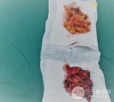 深圳兰乔医院假体隆胸和副乳切除图片案例