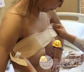深圳兰乔医院假体隆胸和副乳切除图片案例