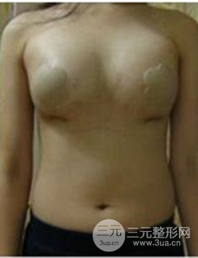 潍坊华美任传琦给我做的假体隆胸手术，给大家分享一下前后照片
