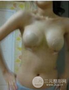 潍坊华美任传琦给我做的假体隆胸手术，给大家分享一下前后照片