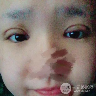 汕头爱丽诺苏国艺给我做的双眼皮手术，把前后的对比图片分享给大家