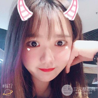 汕头爱丽诺苏国艺给我做的双眼皮手术，把前后的对比图片分享给大家