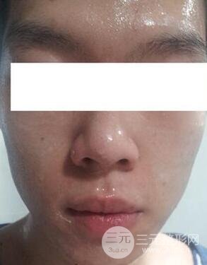 汕头爱丽诺时慧医生给我做的祛痘，看看前后果如何