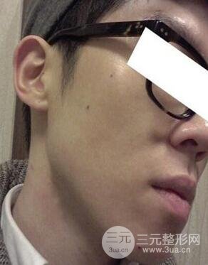 汕头爱丽诺时慧医生给我做的祛痘，看看前后果如何