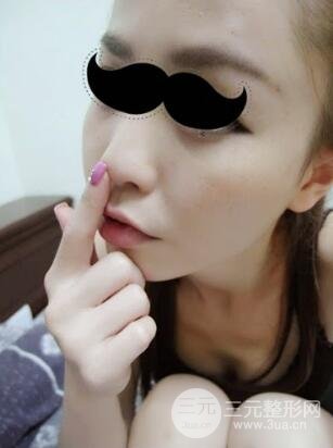 埋埋蛋白线.提升真实案例分享：汕头爱丽诺时慧医生做的