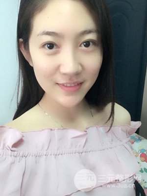 双眼皮修复+开内眼角真实案例附上前后对比图片——汕头伊丽莎白张红军做的