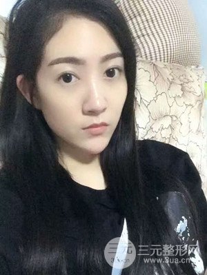 双眼皮修复+开内眼角真实案例附上前后对比图片——汕头伊丽莎白张红军做的