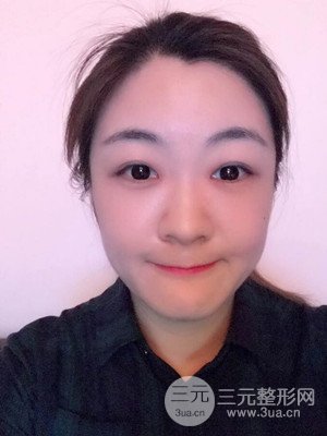 做了自体脂肪填充全脸日记分享——汕头伊丽莎白孙杰医生做的