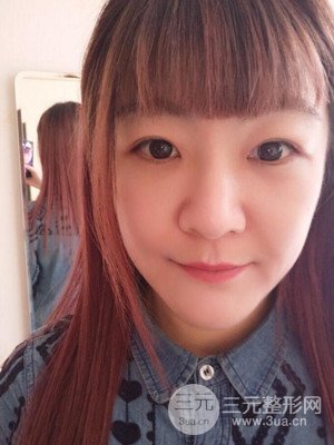 做了自体脂肪填充全脸日记分享——汕头伊丽莎白孙杰医生做的