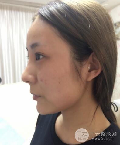 注射玻尿酸注射除皱紧致肌肤前后对比图案例