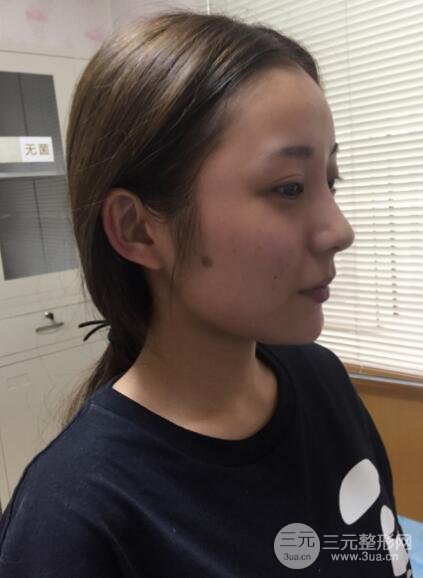 注射玻尿酸注射除皱紧致肌肤前后对比图案例