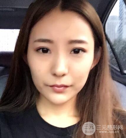 注射玻尿酸注射除皱紧致肌肤前后对比图案例