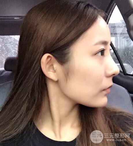 注射玻尿酸注射除皱紧致肌肤前后对比图案例