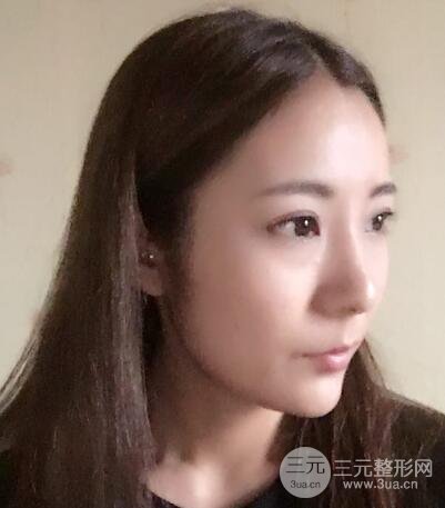 注射玻尿酸注射除皱紧致肌肤前后对比图案例