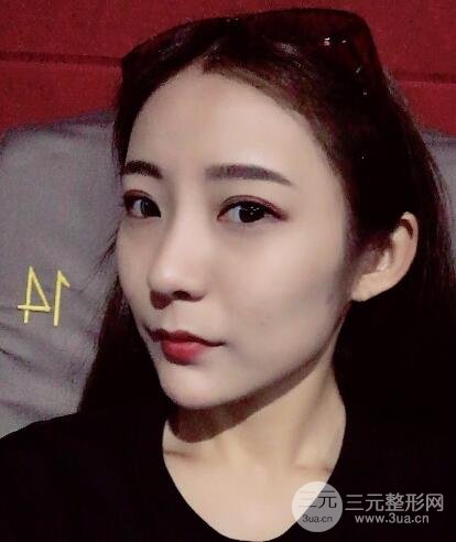 注射玻尿酸注射除皱紧致肌肤前后对比图案例