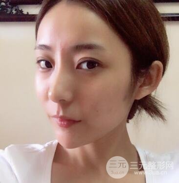 注射玻尿酸注射除皱紧致肌肤前后对比图案例