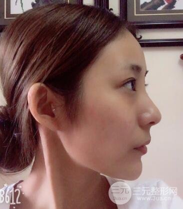 注射玻尿酸注射除皱紧致肌肤前后对比图案例