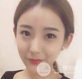 注射玻尿酸注射除皱紧致肌肤前后对比图案例