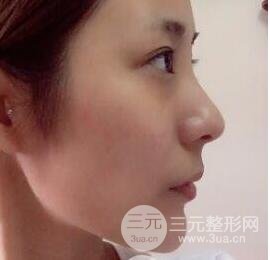 注射玻尿酸注射除皱紧致肌肤前后对比图案例