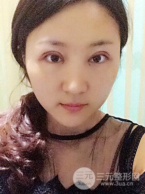 汕头伊丽莎白孙杰医生给我做的切开双眼皮手术，分享一下前后对比图片