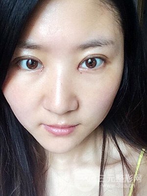 汕头伊丽莎白孙杰医生给我做的切开双眼皮手术，分享一下前后对比图片