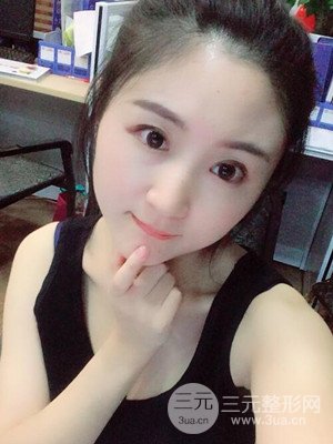 汕头伊丽莎白孙杰医生给我做的切开双眼皮手术，分享一下前后对比图片