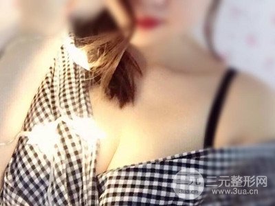 宜昌中爱张宜彬医生给我做的假体隆胸手术，分享一下前后照片