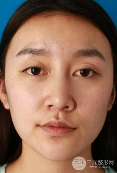 深圳源美做隆鼻失败修复价格案例