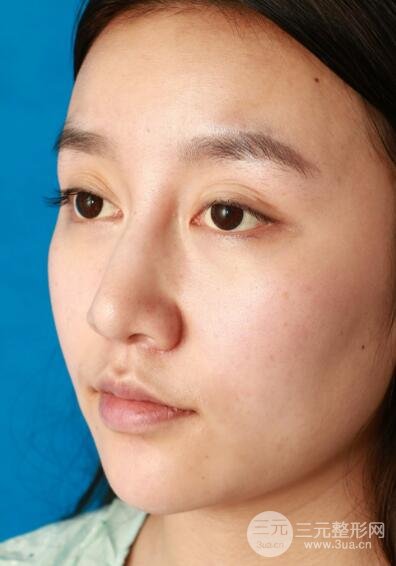 深圳源美做隆鼻失败修复价格案例