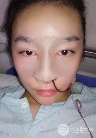深圳源美做隆鼻失败修复价格案例