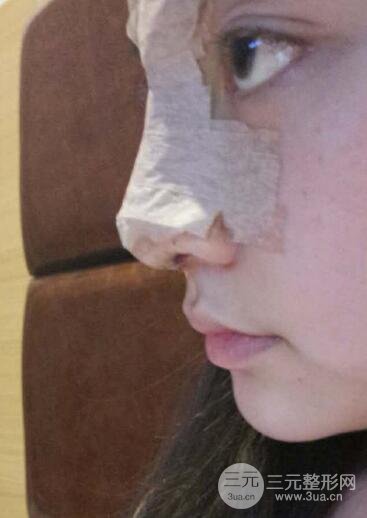 深圳源美做隆鼻失败修复价格案例