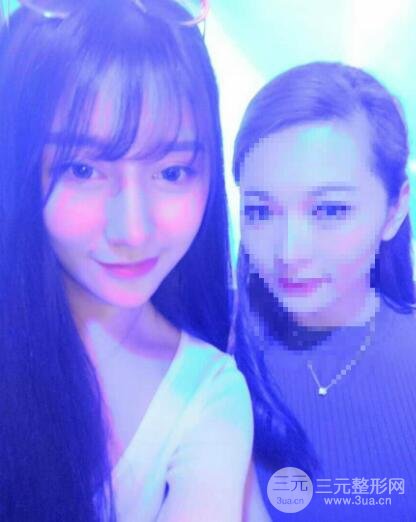 深圳源美做隆鼻失败修复价格案例