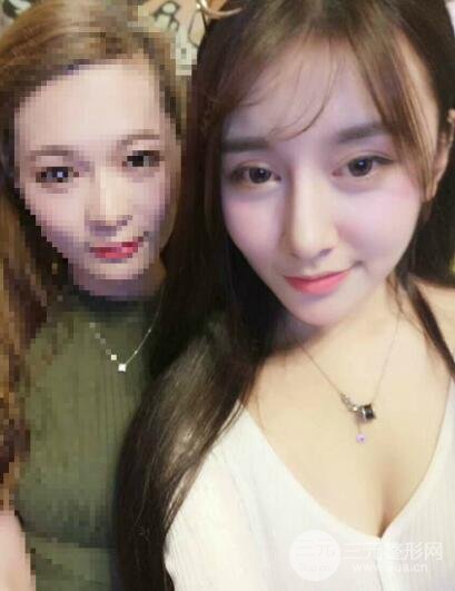 深圳源美做隆鼻失败修复价格案例