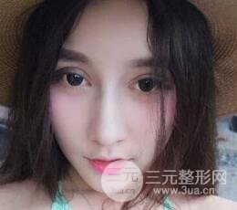 深圳源美做隆鼻失败修复价格案例