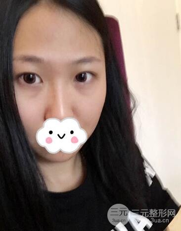 切开双眼皮无疤痕增生果好图片案例分享