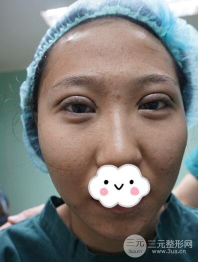 切开双眼皮无疤痕增生果好图片案例分享