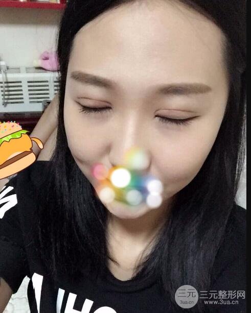 切开双眼皮无疤痕增生果好图片案例分享