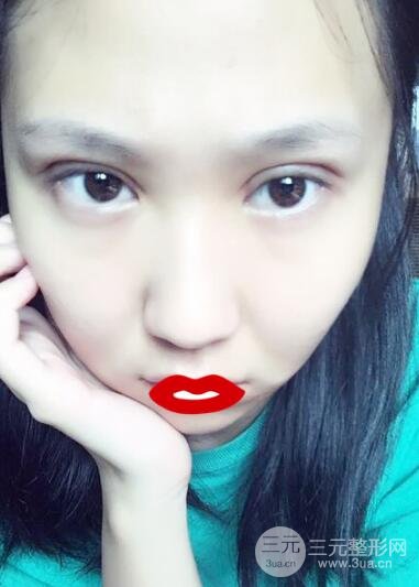 切开双眼皮无疤痕增生果好图片案例分享