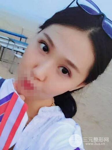 切开双眼皮无疤痕增生果好图片案例分享