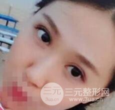 切开双眼皮无疤痕增生果好图片案例分享