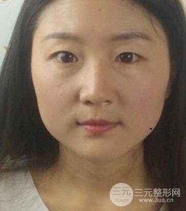 单眼皮割双眼皮成功案例图片