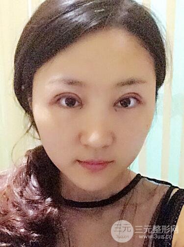 单眼皮割双眼皮成功案例图片