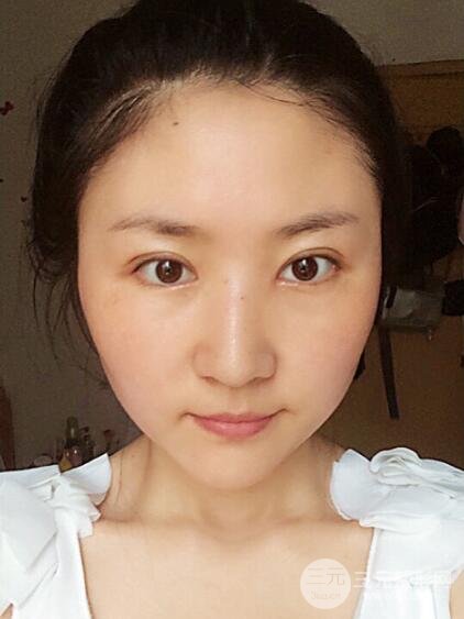单眼皮割双眼皮成功案例图片