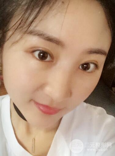 单眼皮割双眼皮成功案例图片