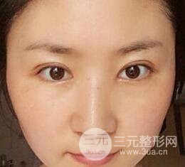 单眼皮割双眼皮成功案例图片