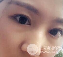 单眼皮割双眼皮成功案例图片