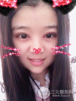 切开双眼皮+开内眼角真实案例，并附上前后对比图片