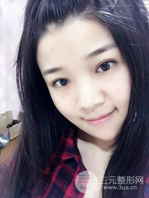 切开双眼皮+开内眼角真实案例，并附上前后对比图片