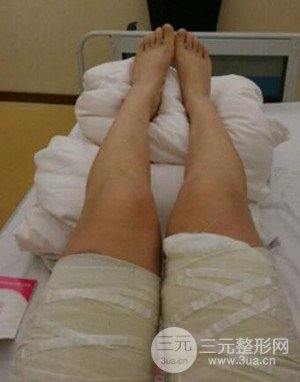 大腿抽脂案例 大腿抽脂前后对比图